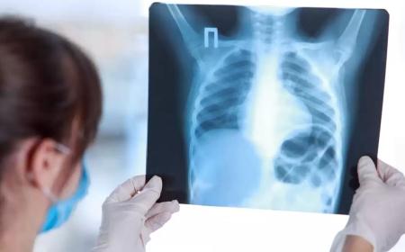 En Pando confirman 34 personas con tuberculosis en lo que va del año