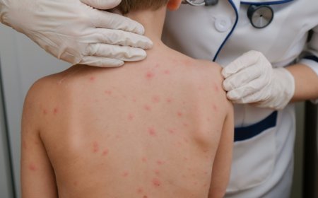 Aumentan a 14 los casos de sarampión