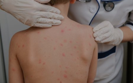 En Bolivia suman más de 60 casos confirmados de sarampión