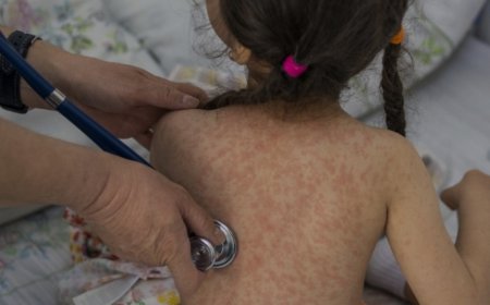 Sedes cuentan con vacunas contra el sarampión para la campaña