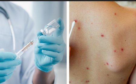 Bolivia cuenta con más de 1 millón de dosis contar el sarampión