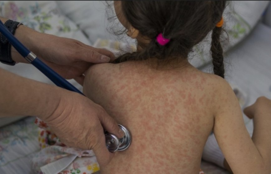 Sedes cuentan con vacunas contra el sarampión para la campaña