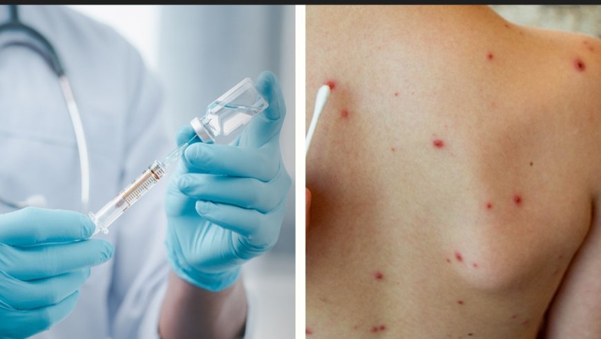 Bolivia cuenta con más de 1 millón de dosis contar el sarampión