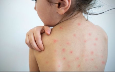 Bolivia reporta 213 casos de sarampión