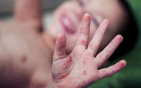 Sedes La Paz confirma dos nuevos casos de sarampión