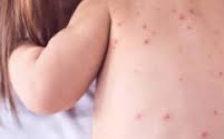 Estados Unidos registra 588 casos de sarampión en enero